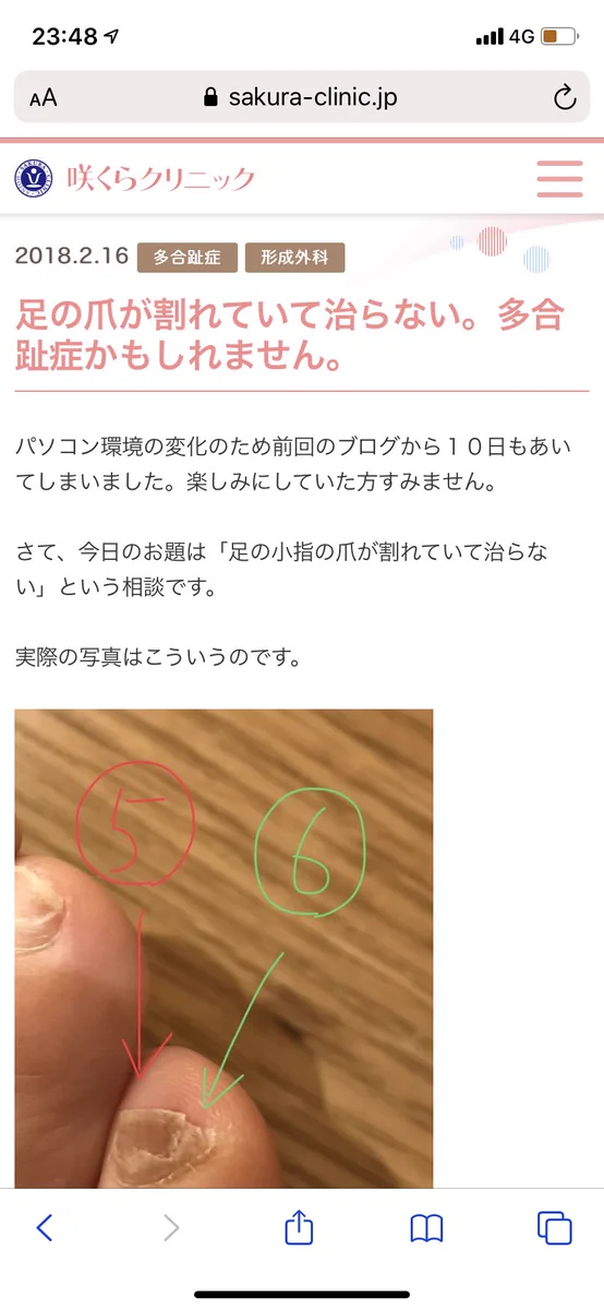 えー!そうなの？！「両足の小指の爪の端が割れて生えている人」。それは「第6の指」である可能性があるらしい。