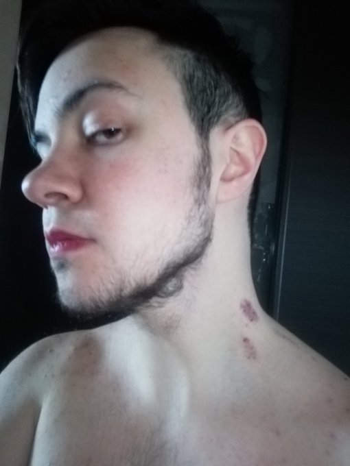 Last night was hooot, just look on my neck!!! https://t.co/8pBGmS2fZU<a href="/tag/legs"class="tags"><span>#legs</span></a><a href="/tag/heels"class="tags"><span>#heels</span></a><a href="/tag/queer"class="tags"><span>#queer</span></a><a href="/tag/hairy"class="tags"><span>#hairy</span></a><a href="/tag/ftm"class="tags"><span>#ftm</span></a>
