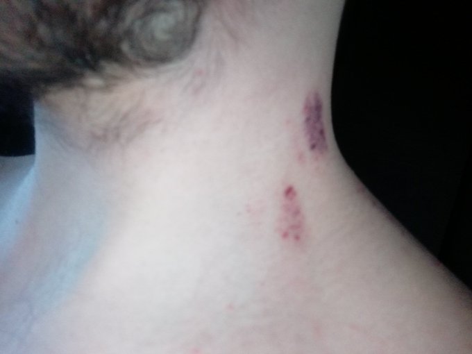 Last night was hooot, just look on my neck!!! https://t.co/8pBGmS2fZU<a href="/tag/ftm"class="tags"><span>#ftm</span></a><a href="/tag/ahegao"class="tags"><span>#ahegao</span></a><a href="/tag/transguy"class="tags"><span>#transguy</span></a>