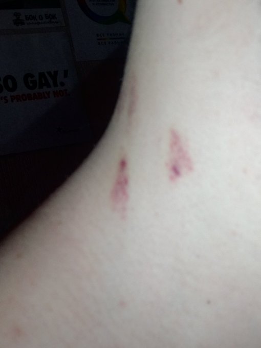 Last night was hooot, just look on my neck!!! https://t.co/8pBGmS2fZU<a href="/tag/ftm"class="tags"><span>#ftm</span></a><a href="/tag/ahegao"class="tags"><span>#ahegao</span></a><a href="/tag/transguy"class="tags"><span>#transguy</span></a>