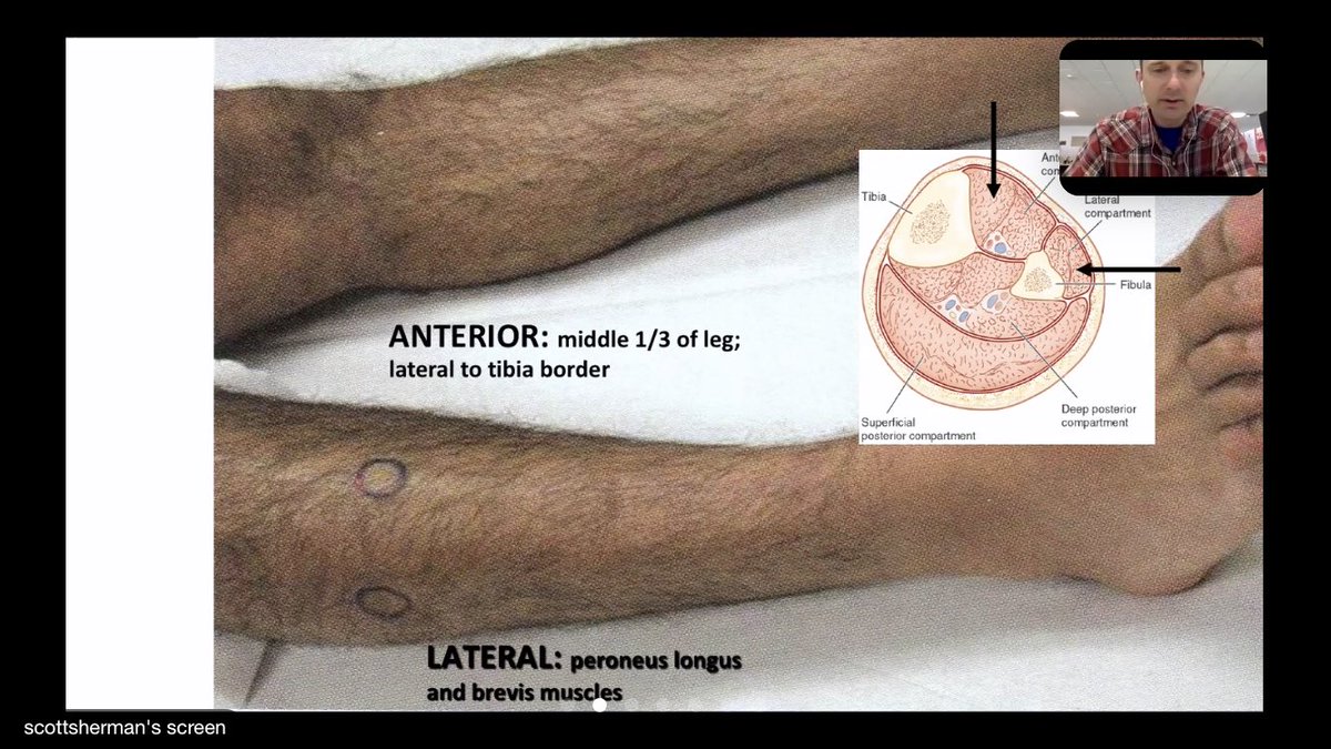 DJShahMD's tweet image. Concerned about compartment syndrome? Know where to place your stryker #EMConf @CookCountyEM #Orthotips