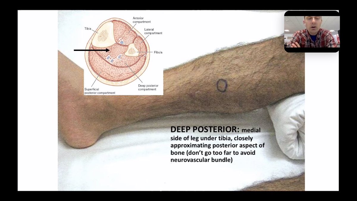 DJShahMD's tweet image. Concerned about compartment syndrome? Know where to place your stryker #EMConf @CookCountyEM #Orthotips