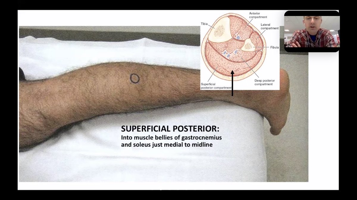 DJShahMD's tweet image. Concerned about compartment syndrome? Know where to place your stryker #EMConf @CookCountyEM #Orthotips