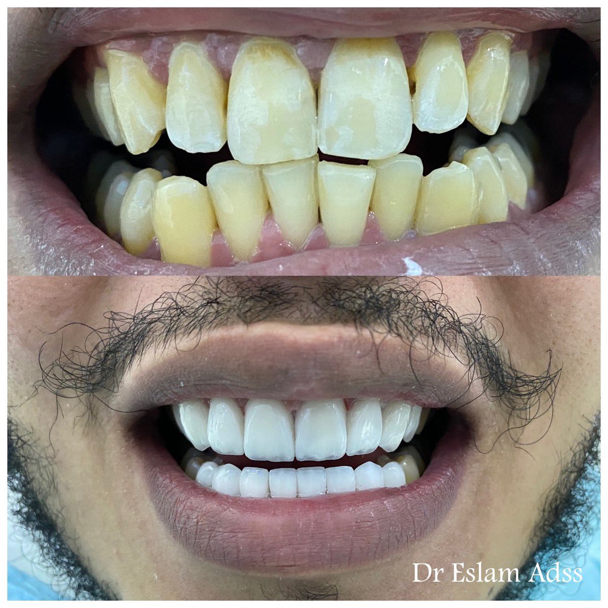 dreslamadss's tweet photo. 6فائزين
#عيادات_الدكتور_اسلام_عدس_لتجميل_وتركيبات_الاسنان
#صفوة_المهيدب_لطب_الاسنان #المدينة_المنورة 
1)خصم3000ريال ع #ابتسامة_هوليود 
2)كوبون500ريال ع اي اجراء داخل العياده
3)تبييض منزلي مجاني
4)5)6)هدايا مختلفه
تابع الحساب@dreslamadss
ريتويت
السحب5شوال
#السناب 
#جود_الجماهير https://t.co/8iYaONfBLR