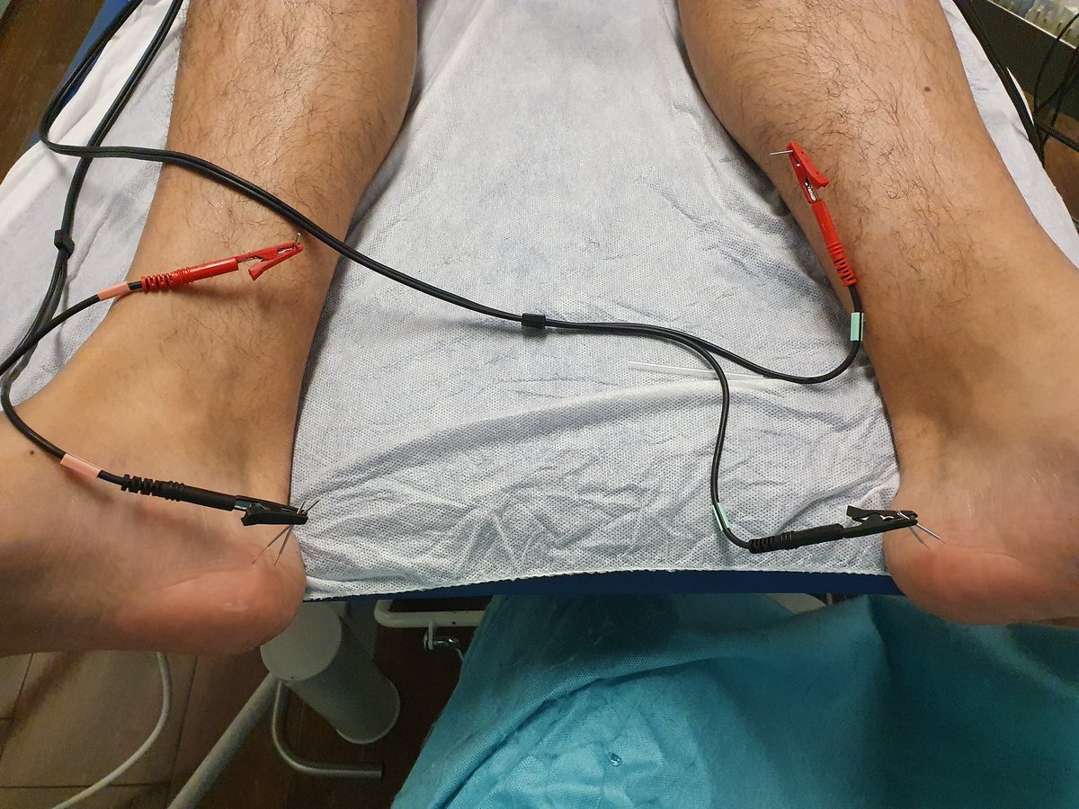 Hoy en <a href="/fisiojreig/">fisiojreig</a> Estimulación ramas calcaneas #neuromodulacion #Ecografia seguimos !!!!