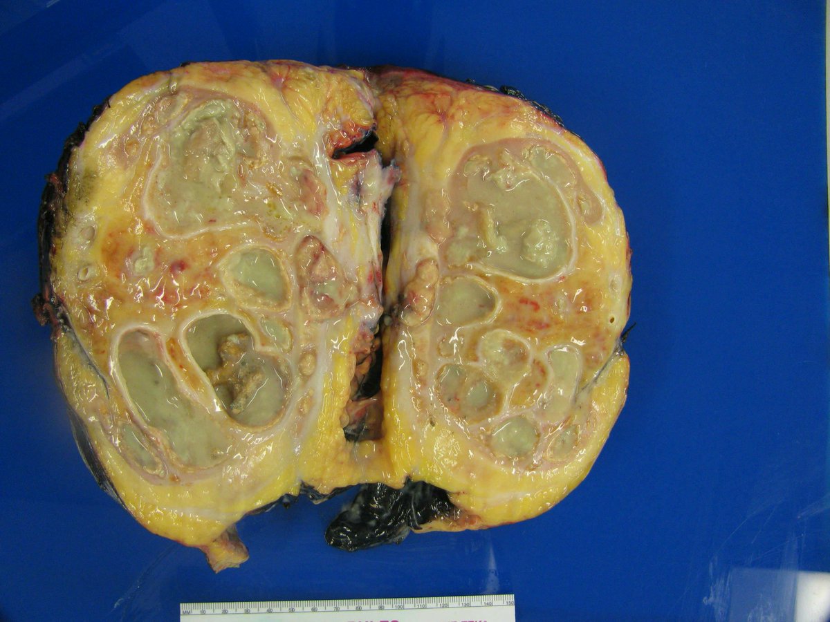 LaraHarikMD's tweet photo. "Very gross" Gross diagnosis #GUPATH #PATHGROSS https://t.co/Wz4xPMJ18J
