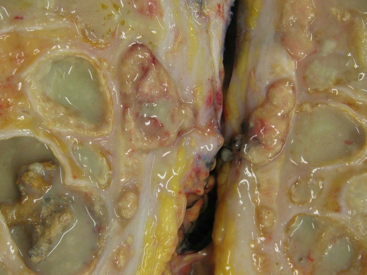 LaraHarikMD's tweet photo. "Very gross" Gross diagnosis #GUPATH #PATHGROSS https://t.co/Wz4xPMJ18J