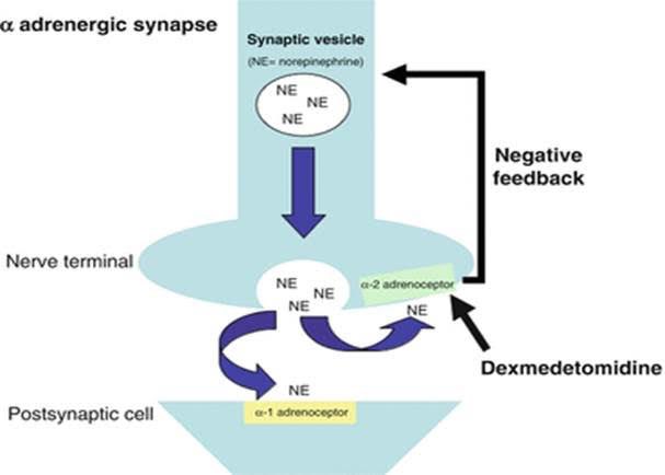 BMCPharmRes's tweet photo. PGY1 @JenningsPharm recalled a case &amp; novel pain control strategy💡 for #SickleCell pts in VOC

If there is escalating pain scores despite optimized multi-modal pain management, #dexmedetomidine can be used as an alternative if pt is hemodynamically stable &amp; can be monitored 🩺 https://t.co/dKk8fMmsn2