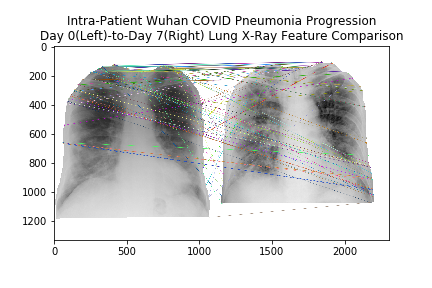 ZiaShaun's tweet photo. @josephpaulcohen @MarzyehGhassemi #ElissaStrome #doinaprecup #yoshuabengio @MILAMontreal @VectorInst @CIFAR_News @DeepMind @OxfordAI #COVID19 #MachineLearning - Day 0(Left)-to-Day 7(Right) - Frontal lung X-ray feature comparison - Elderly male from Wuhan, China - 100 matches https://t.co/KneNfdGw9L