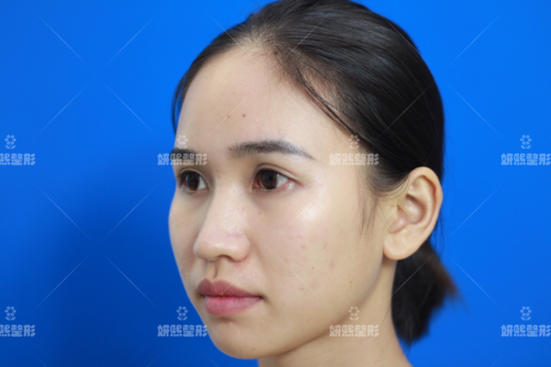 ドリーム中国美容整形 施術内容 プロテーゼ 耳介軟骨移植 鼻翼縮小 皮膚を部分的に切除し 皮下組織を糸で縫合して 小鼻を小さくする施術です 傷跡 術後数日間 メイク で隠せる程度 糸の影響 鼻の違和感など 時間経過で解消 小鼻縮小
