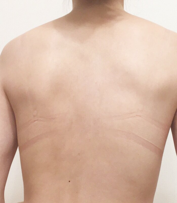 こじみく 24hブラのプロデューサー 育乳ブラを無理して使ったことで跡 が残り色素沈着してしまった というご相談を時々頂きます バストは締めつけて大きくなるわけではないので少しでもこんな跡が残ってたらサイズや商品を見直してください 締めつけは