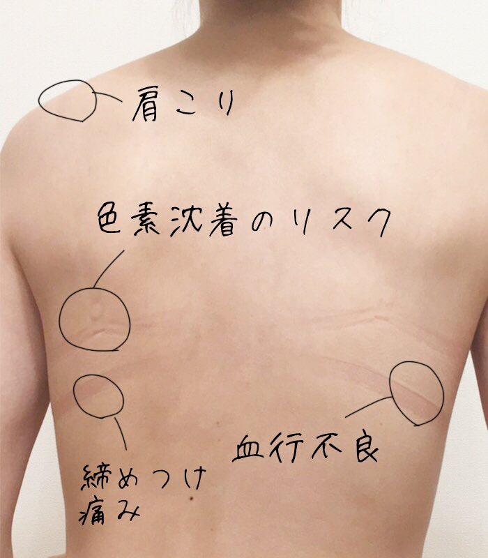こじみく 下着開発歴10年 on X 育乳ブラを無理して使ったことで跡が残り色素沈着してしまった というご相談を時 頂きます バストは締めつけて大きくなるわけではないので少しでもこんな跡が残ってたらサイズや商品を見直してください 締めつけは百害あって一利