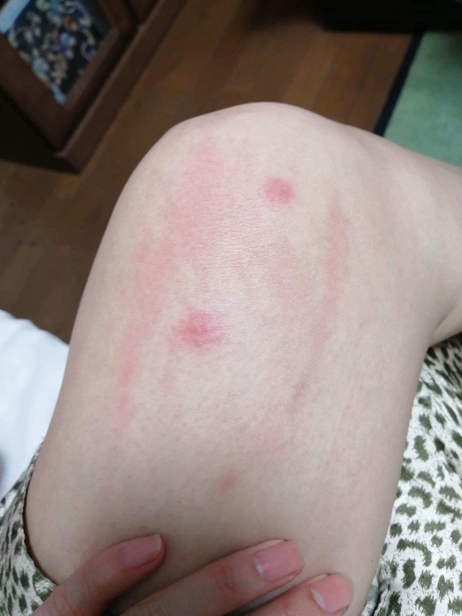 刺され ない ダニ 治ら