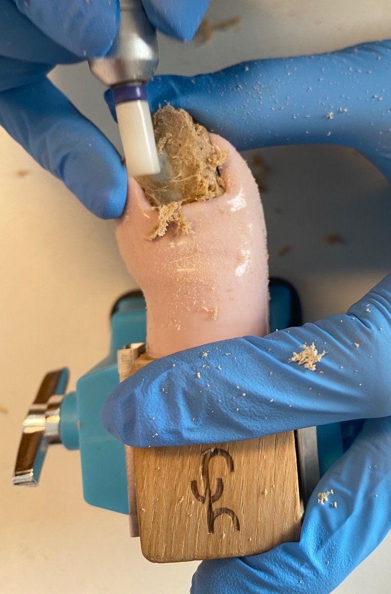 JToe11's tweet photo. Another nail deformation: a nail with a fungal lesion 👣

Many fungal lesions affect the nails. The nail developed by us is a safe solution to learn how to clean and take the material for examination 👣

#mycosis #toenail #podology  #JToe https://t.co/9MFWaBwZfG