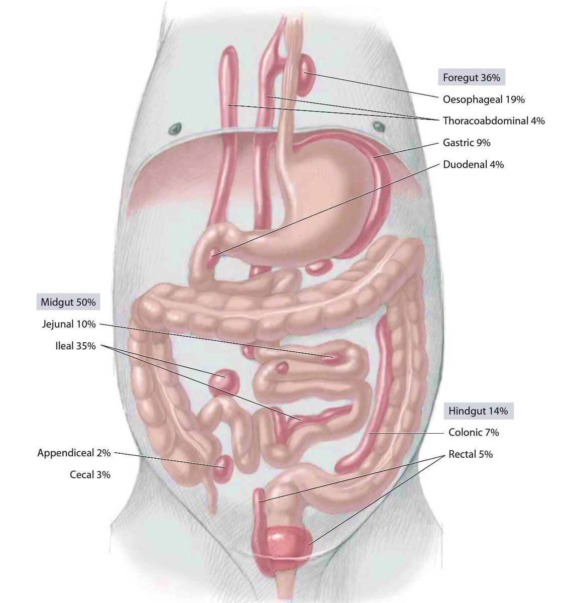 CirugiaPediaMx's tweet photo. Duplicaciones del sistema digestivo
Localizaciones más frecuentes 👶🏻👍🏻
#SoMe4PedSurg https://t.co/Q5LL876lWy