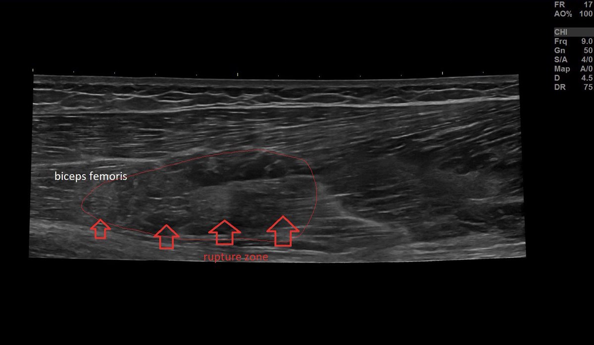 SportklinikBern's tweet photo. #hamstringinjury #bicepsfemoris #muscletear #footballinjury #mskus #pocus #pocushub #logicview #gehealthcare #s7r3 https://t.co/MTsuwbLmF6