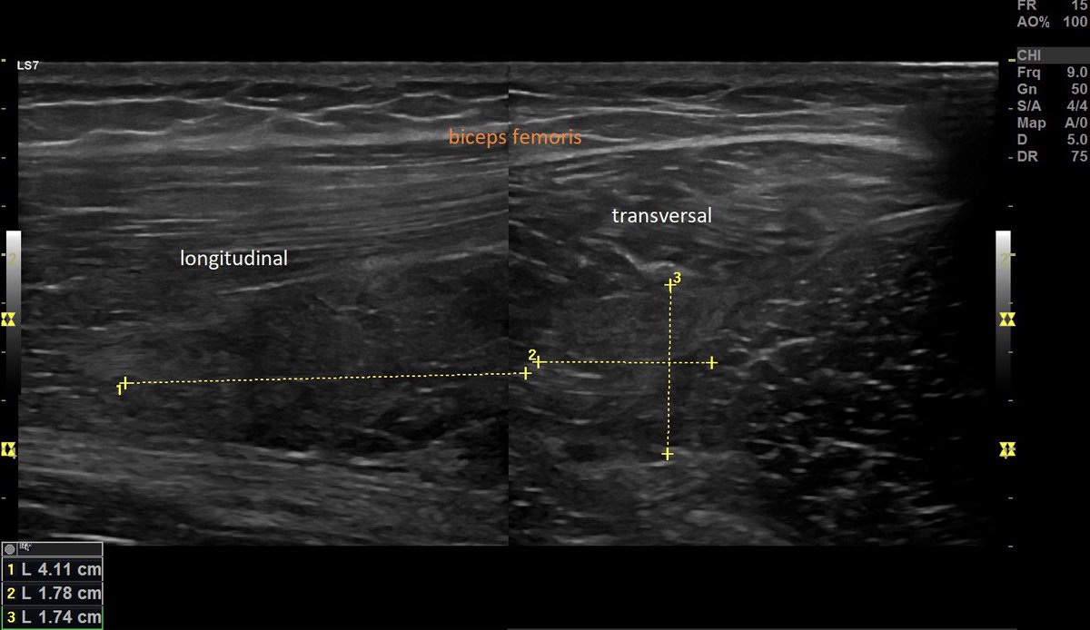 SportklinikBern's tweet photo. #hamstringinjury #bicepsfemoris #muscletear #footballinjury #mskus #pocus #pocushub #logicview #gehealthcare #s7r3 https://t.co/MTsuwbLmF6