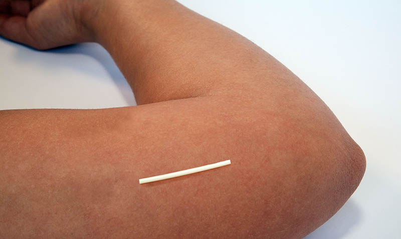 4. Implant. - These are implanted into you arm and contains hormones that prevent pregnancy and can last for 3 yearsIt can be removed at any time and the contraceptive effects cease when it is removed Side effects include irregular periods and weight gain.