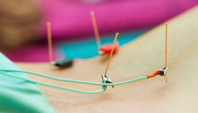 Considering Electro-Acupuncture? Research shows #ElectroAcupuncture can stop chronic pain, increase circulation &amp; boost your immunity. Find out if it's right for you. easternwellnessacupuncture.com/what-is-electr…
#easternwellness #acupuncure #scarsdalemedical #chronicpain #wecanhelp #naturalpainrelief