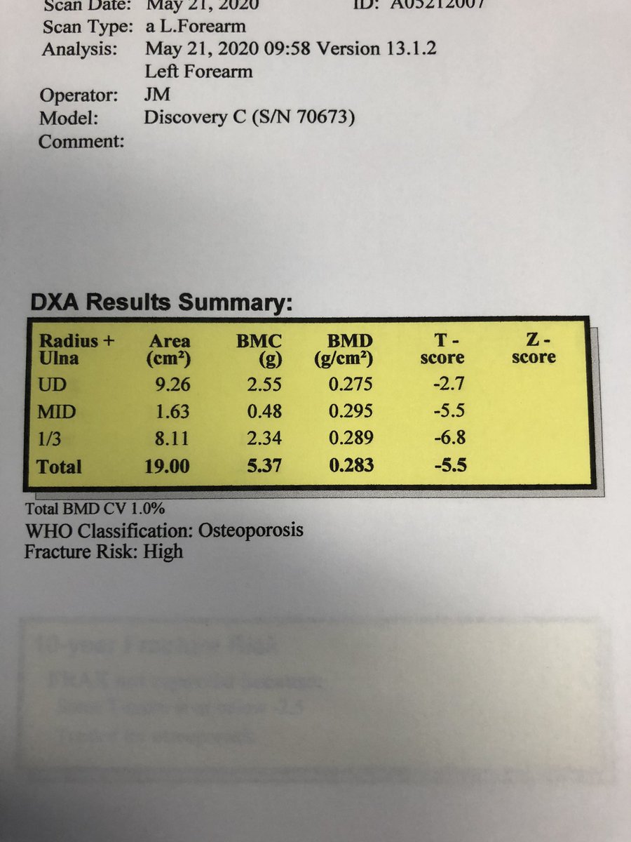 dougbeall's tweet photo. Saw this patient back today after #Kyphoplasty on all levels of her lumbar spine giving a T score of 23.8...lol! The T score of -5.5 overall helps explain why she had so many fractures. Doing great and now on #Tymlos https://t.co/bKlHilPwWY
