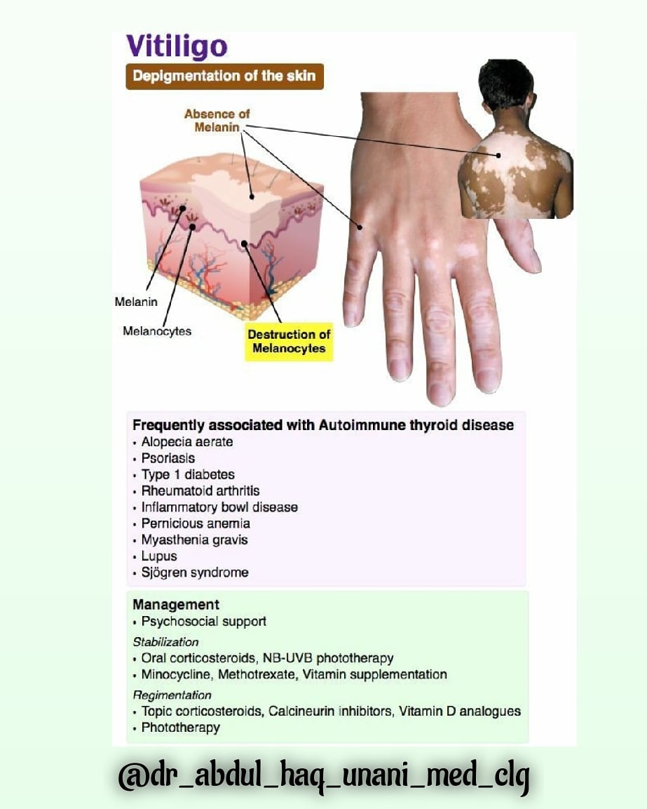 drahumc's tweet photo. Vitiligo: depigmentation of skin 
Tags follow:
#dr_abdul_haq_unani_medical_college 
#unanimedicine 
#unite4unani 
#unani_unani 
#unanisimplify 
#ayushunani https://t.co/imAGMnJTPk