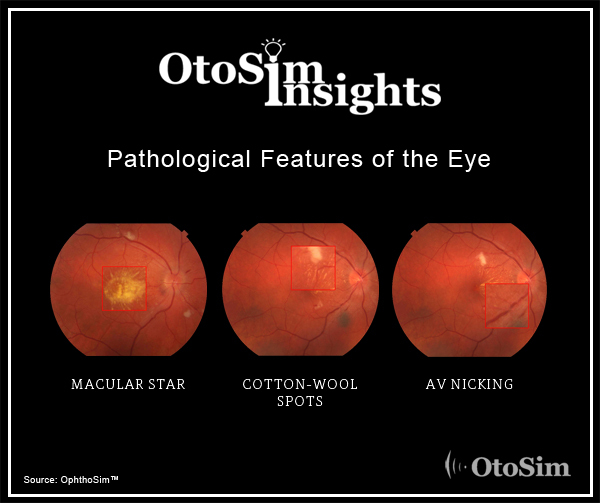 Cotton Wool Spots Vs Hard Exudates