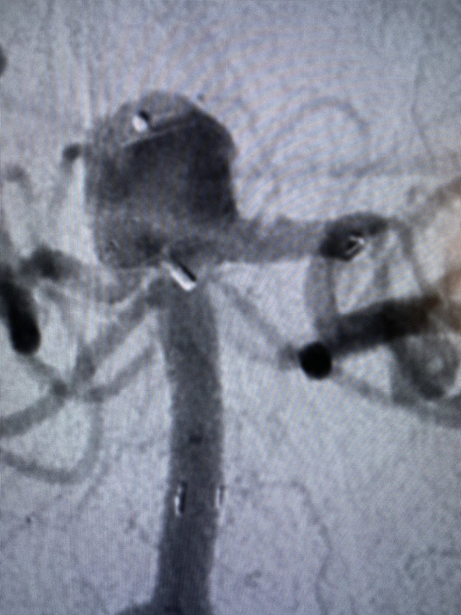 JustinSingerMD's tweet photo. #Atlas assisted #Web for wide-neck basilar aneurysm with great great #BrainAneurysm projection with stasis and left PCA protection. #Neurosurgery #SpectrumNeuroscience #WebIt #Microvention https://t.co/i6RUAXs2BT