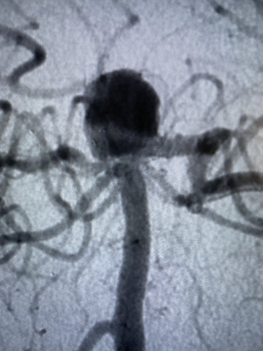 JustinSingerMD's tweet photo. #Atlas assisted #Web for wide-neck basilar aneurysm with great great #BrainAneurysm projection with stasis and left PCA protection. #Neurosurgery #SpectrumNeuroscience #WebIt #Microvention https://t.co/i6RUAXs2BT