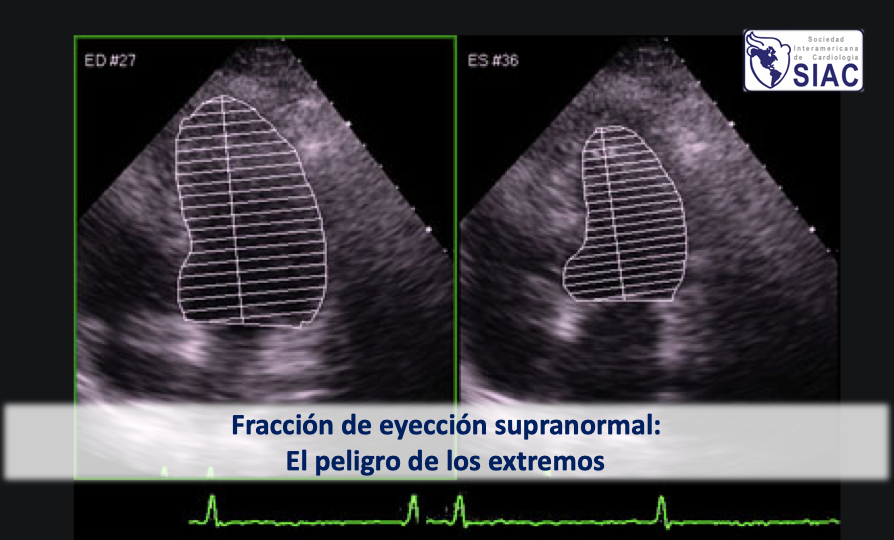 SIAC_cardio's tweet photo. Fracción de eyección supranormal: el peligro de los extremos
Según este estudio, existe una curva en U entre la FE y mortalidad, con nadir entre 60-65%
Editorial del Dr.@juanicotella 🇦🇷
#LideresEmergentesSIAC 

https://t.co/UwdAyyMft6 https://t.co/0vrqQsaVfq