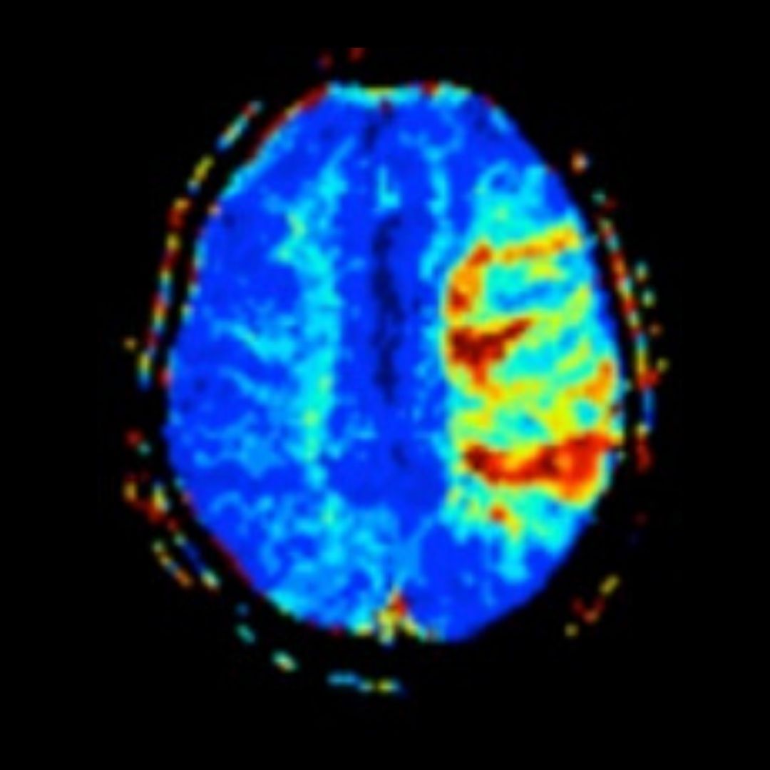 The_IMJ's tweet photo. IMJ May #freeaccess Editor's Choice - Endovascular clot retrieval for M2 segment middle cerebral artery occlusion - https://t.co/KQrjqLw4WT

@marrow @TheRACP @Wiley_Health @JulianMaingard @MonashHealth @SalamFindakly @DavidBlacker4 @SzeTingLee2 @Austin_Health @Deakin https://t.co/5wjyAQb7Pb