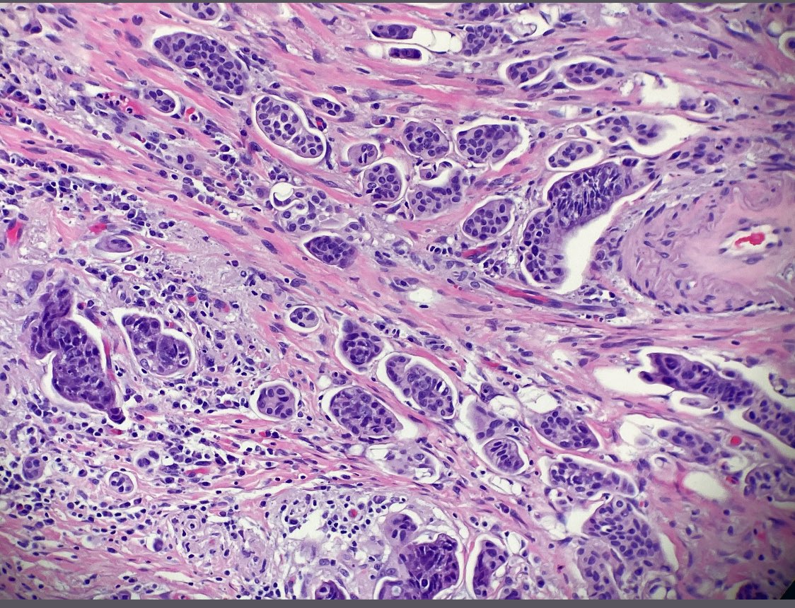 NRiddleMD's tweet photo. Focal area in an otherwise moderately differentiated colon adeno... Would you call micropapillary? I mentioned there might be some during tumor board 🤷♀️ #NotMyCase #GIPath https://t.co/PZBJTI09oB