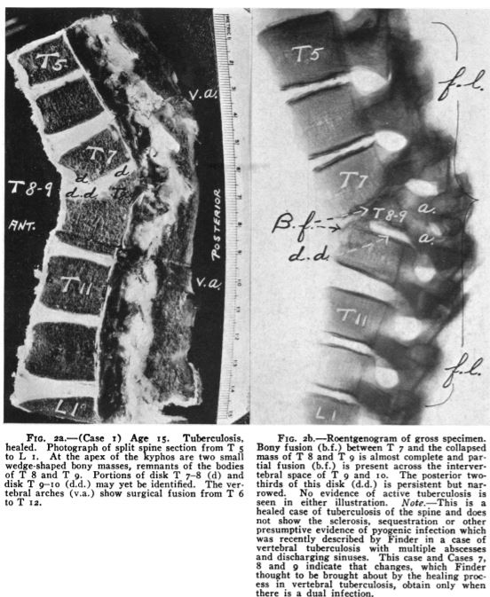 9/13In 1936, Compere and Garrison from  @UChicago provided description of vertebral TB, comparing radiologic + path/autopsy findings. Also compared TB spondylitis to pyogenic infection, and they noted that anterior vertebral body was affected moreRef:  https://bit.ly/2ylJTbc 