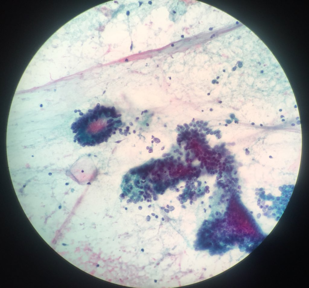 TCytologist's tweet photo. After a while 
Case on working today,female 36 years. Pap smear ,pap stain.
What do you think ?🔬🔬🦠🦠 #cytology  #papstain #cytopatho #cytopath  #cytotechnologist #cytologists https://t.co/mkhcKqEBED