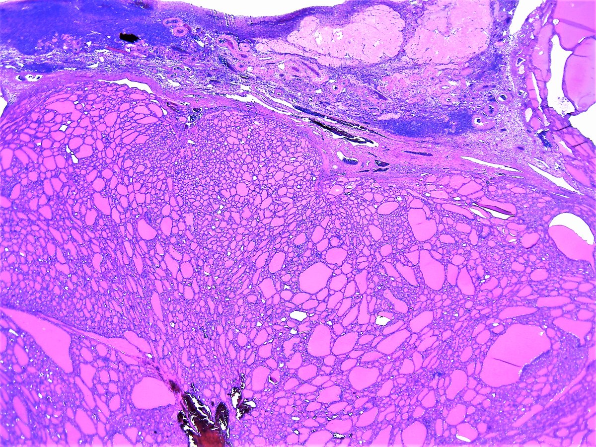Pathology WalkerAuto Tweet Bot on Twitter "Struma ovarii. Ovary