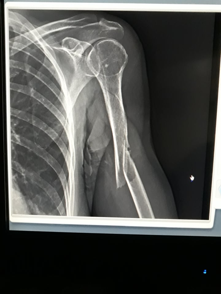 aixagar90086508's tweet photo. mi nombre es Aixa tengo 60 anos vivo en Venezuela actualmente estoy pasando una situación fuerte me caí en mi casa y me fracture el humero actualmente no cuento con los recuersos para operarme de emergencia espero me puedan ayudar para colocar el tutor que necesito o difundiendo https://t.co/hstCczWqnZ