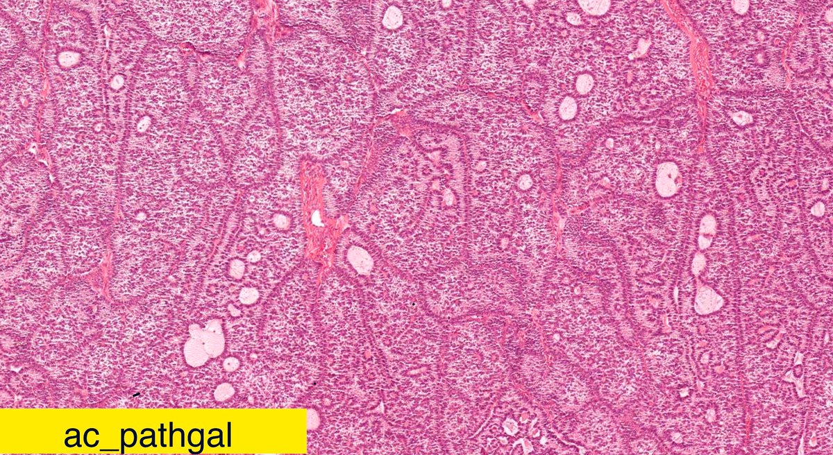 ac_pathgal's tweet photo. Spotter10. Ovarian mass. Can you tell the clinical syndrome associated with it. Be back Monday! #gynpath #pathharrryspotter @NKcell_MD @KarrsJeremiah @DrGeeONE @5_3shivani @doc_kartik @HansiniMD @ApekshaNas @YoussefK_MD @vichemecytopath @IUraizee3MD @vi_monappa https://t.co/3DuW1q0Ycy