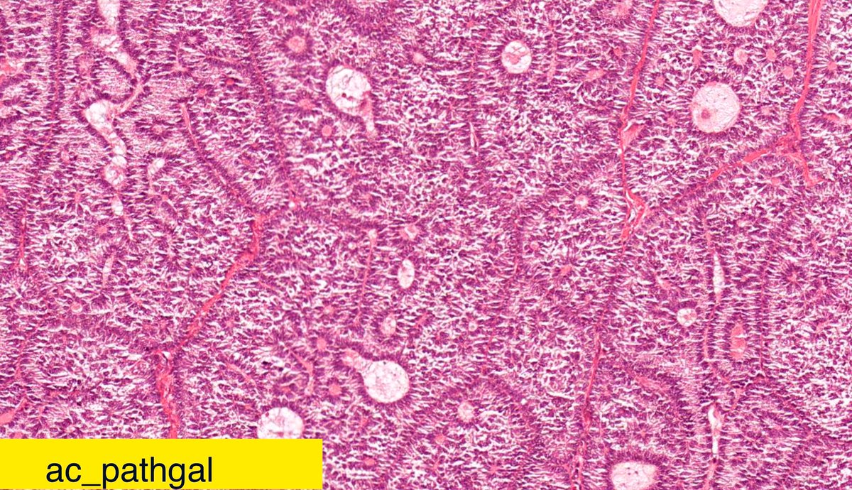 ac_pathgal's tweet photo. Spotter10. Ovarian mass. Can you tell the clinical syndrome associated with it. Be back Monday! #gynpath #pathharrryspotter @NKcell_MD @KarrsJeremiah @DrGeeONE @5_3shivani @doc_kartik @HansiniMD @ApekshaNas @YoussefK_MD @vichemecytopath @IUraizee3MD @vi_monappa https://t.co/3DuW1q0Ycy