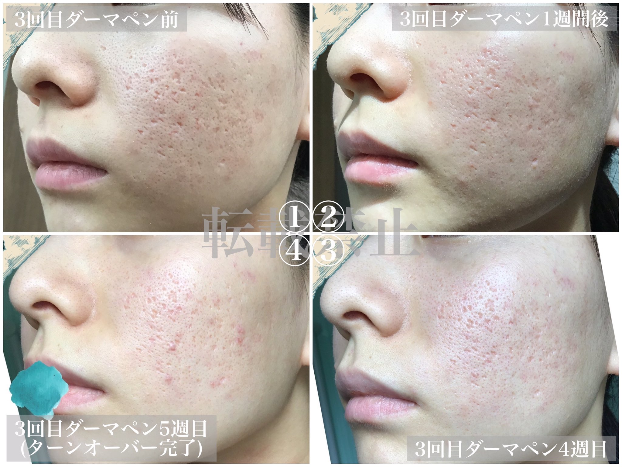 皮膚に穴開け！セルフダーマペン！エンビロン3点セット