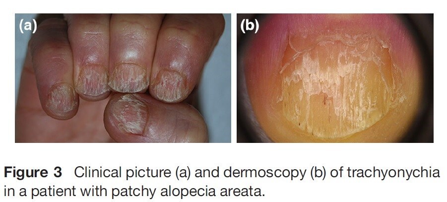 Medanta | Alopecia Areata: Causes, Symptoms, And Treatment
