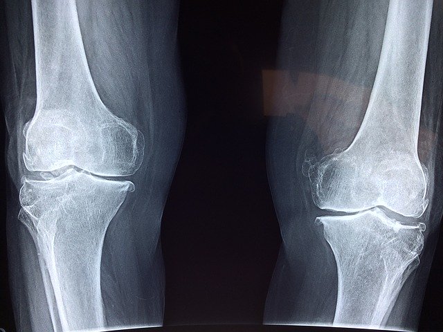 BioMed_21's tweet photo. New review from @ndorms looks at how to replace animals in bone cancer research - taking account of scaffolds, polymers, gel composites, mathematical modelling, ex vivo human bone - many possibilities for #HumanRelevant and #HumanPredictive research.

https://t.co/KgVVt2fR0t https://t.co/saN9OvBgvW