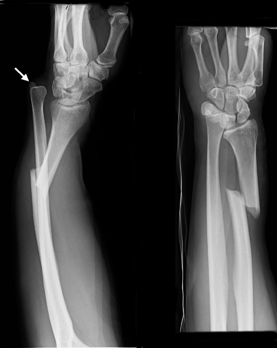 A Galeazzi injury is a fracture of the distal radius with associated dislocated radio-ulna joint, which can be best seen in the lateral view or by widening between the 2 bones! This will require an ORIF to relocate the radio-ulna joint