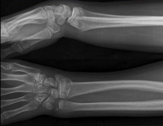 The most common fracture is that of the distal radius!! Fracture here with dorsal displacement of the distal fragment is known as a Colle’s fracture! This is sometimes described as a “dinner fork” deformity.