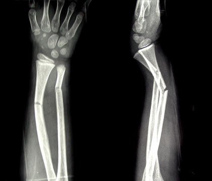 The 2 bones of the forearm can fracture in the same injury, this usually occurs in the midshaft and is inherently unstable and will likely require an ORIF. In children this can be done with flexible intramedullary nails!