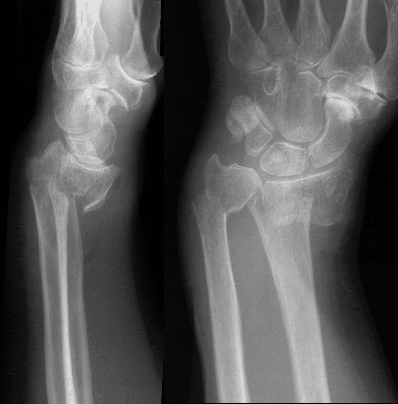 A distal radius fracture with volar displacement of the distal fragment is known as a Smith’s fracture! Sometimes this is described as a “garden spade” deformity.