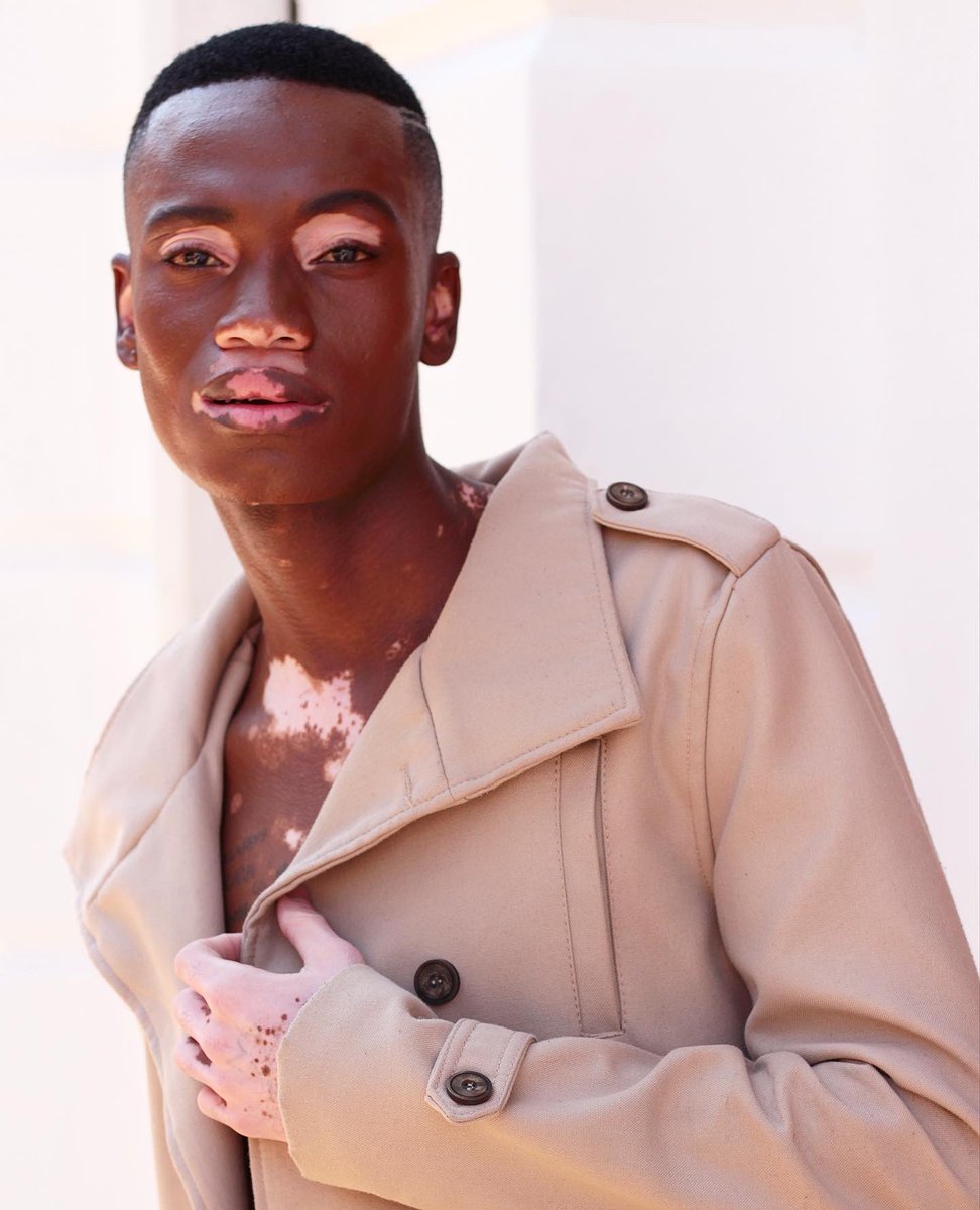 SYNCMM_'s tweet photo. Beauty comes in every shape and form!
Meet: Peter Kolokota 🤍🖤#SYNCModelsNewFace #PeterTheModel.
.
.
.
#vitiligo #vitiligobeauty #vitiligomodel #vitiligoawareness #vitiligoman #MaleModel #FashionModel #Scouted #africanbeauty #syncmodel https://t.co/fWC2LLLuu3