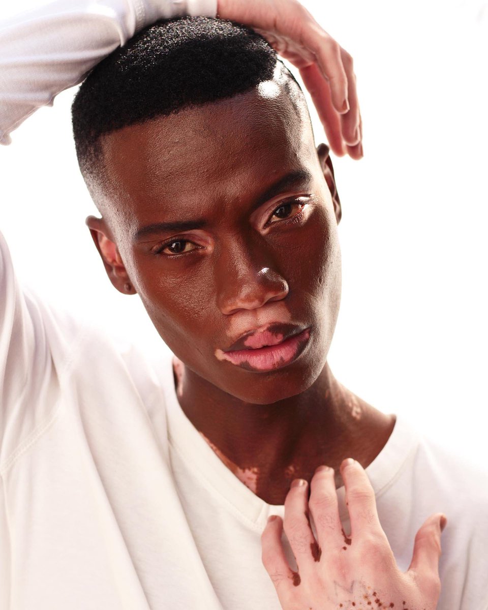 SYNCMM_'s tweet photo. Beauty comes in every shape and form!
Meet: Peter Kolokota 🤍🖤#SYNCModelsNewFace #PeterTheModel.
.
.
.
#vitiligo #vitiligobeauty #vitiligomodel #vitiligoawareness #vitiligoman #MaleModel #FashionModel #Scouted #africanbeauty #syncmodel https://t.co/fWC2LLLuu3