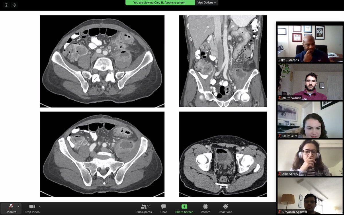 MatthewMDuda's tweet photo. Thank you @CBA_98 for hosting the first @pennsurgery Virtual Sub-I Decision-Making Series! We discussed management for patients with complicated diverticulitis and reviewed recent literature for colectomy versus laparoscopic lavage with perforation https://t.co/3cwCAOH0XD