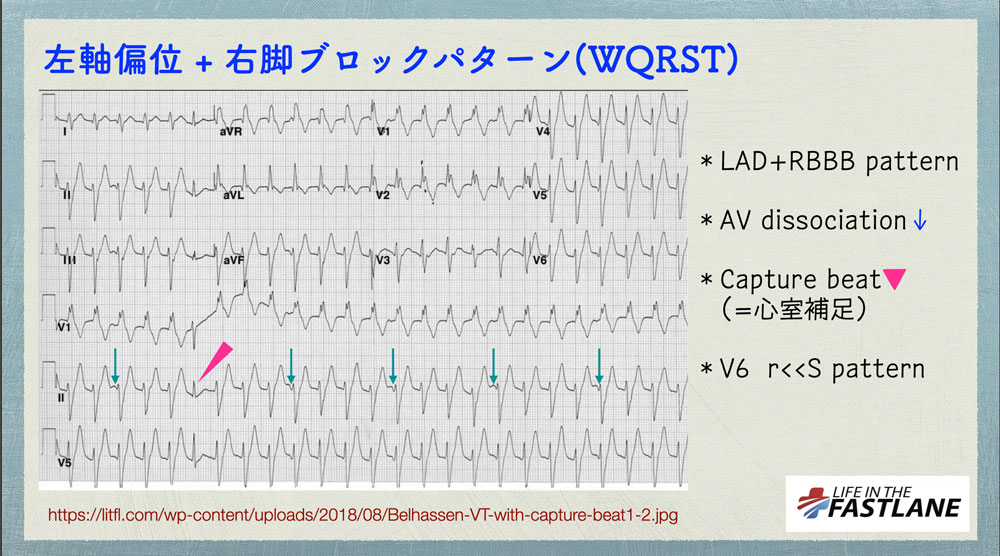 N Tsukishima 心電図検定試験対策 始めました On Twitter 心電図検定試験 Q 6 Answer 09 左脚後枝由来のリエントリー性vt Lad Rbbb Patternとなります 二枝ブロック Crbbb Lad のpsvtとの鑑別は困難 だから 房室解離 によるp波の検出や 心室補足が診断の