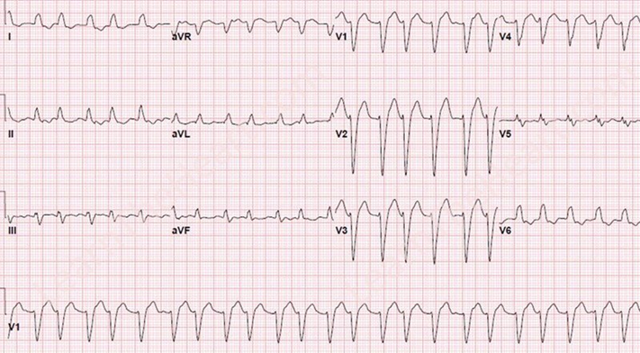 Wide/IrregularDDx: Afib with BBB, Afib with WPW, VF/torsadesDx: this is AF with LBBB