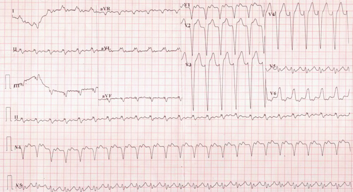 Wide/RegularDDx: VT, SVT or ST with aberrant conductionDx: ST with LBBB; normal P waves give it away
